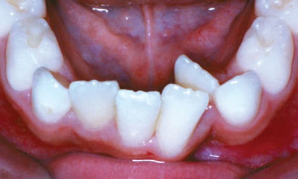 Crowding Marshall Orthodontics in Great Falls, Havre, and Glasgow, MT