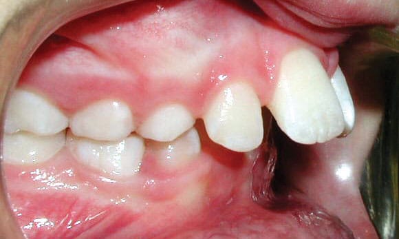 Protrusion Marshall Orthodontics in Great Falls, Havre, and Glasgow, MT