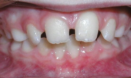 Spacing Marshall Orthodontics in Great Falls, Havre, and Glasgow, MT