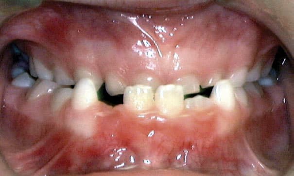 Underbite Marshall Orthodontics in Great Falls, Havre, and Glasgow, MT