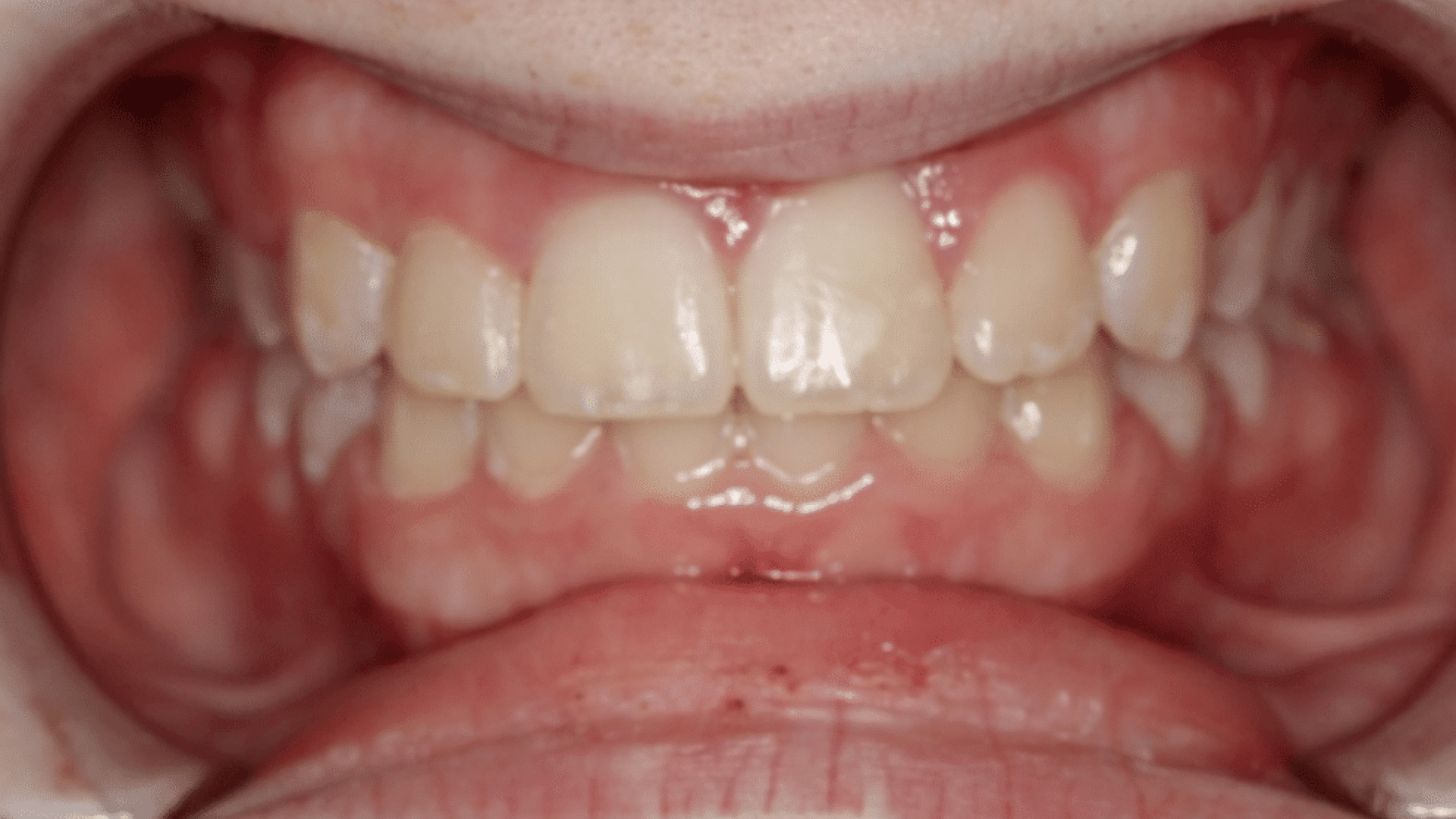 Smile Transformations At Marshall Orthodontics, in Great Falls, Havre, and Glasgow, MT.