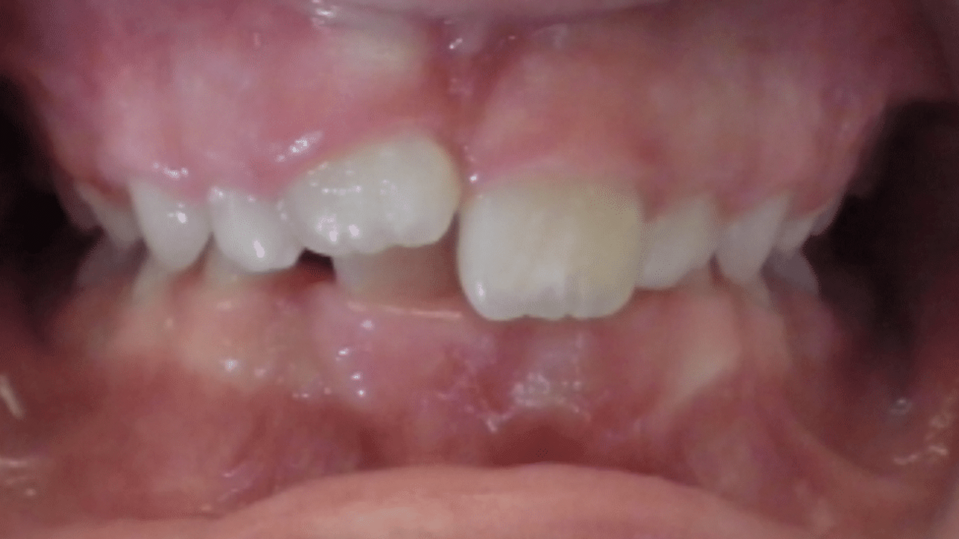 Smile Transformations At Marshall Orthodontics, in Great Falls, Havre, and Glasgow, MT.