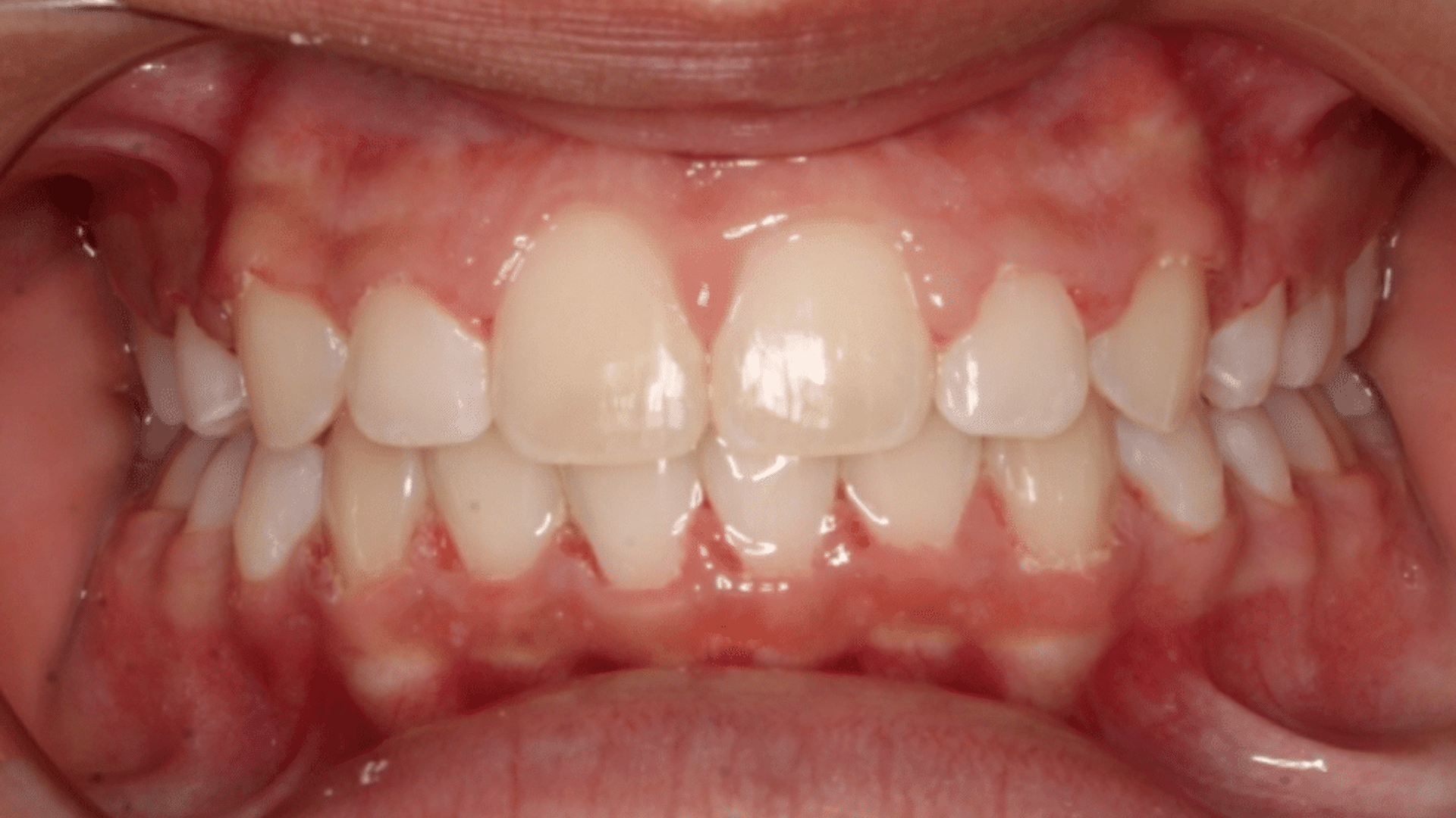 Smile Transformations At Marshall Orthodontics, in Great Falls, Havre, and Glasgow, MT.