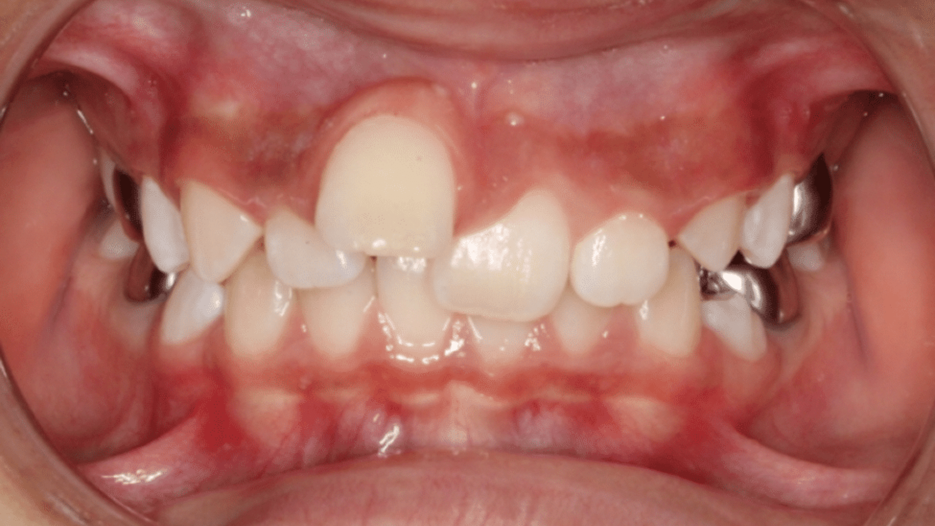 Smile Transformations At Marshall Orthodontics, in Great Falls, Havre, and Glasgow, MT.