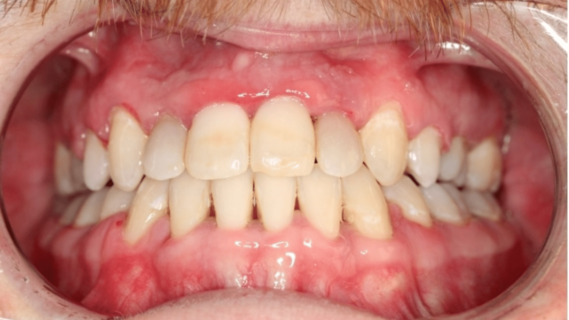 Smile Transformations At Marshall Orthodontics, in Great Falls, Havre, and Glasgow, MT.