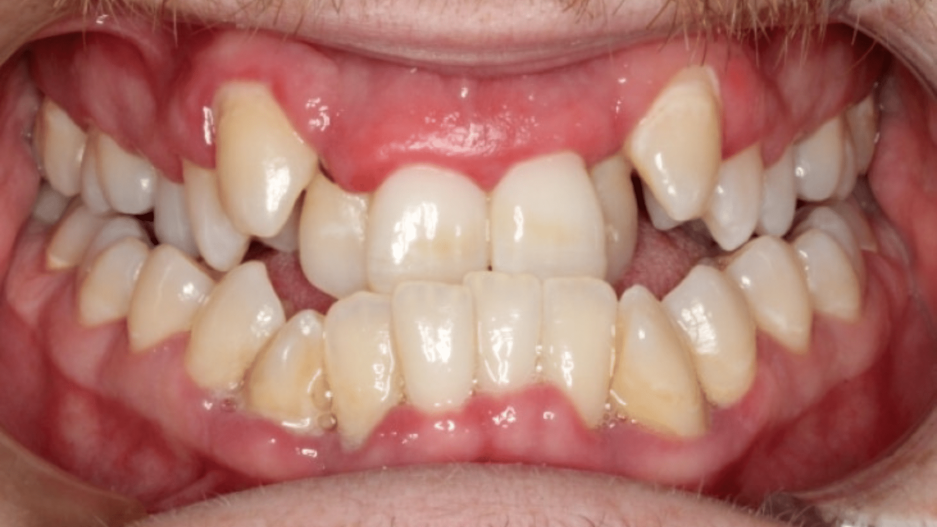 Smile Transformations At Marshall Orthodontics, in Great Falls, Havre, and Glasgow, MT.