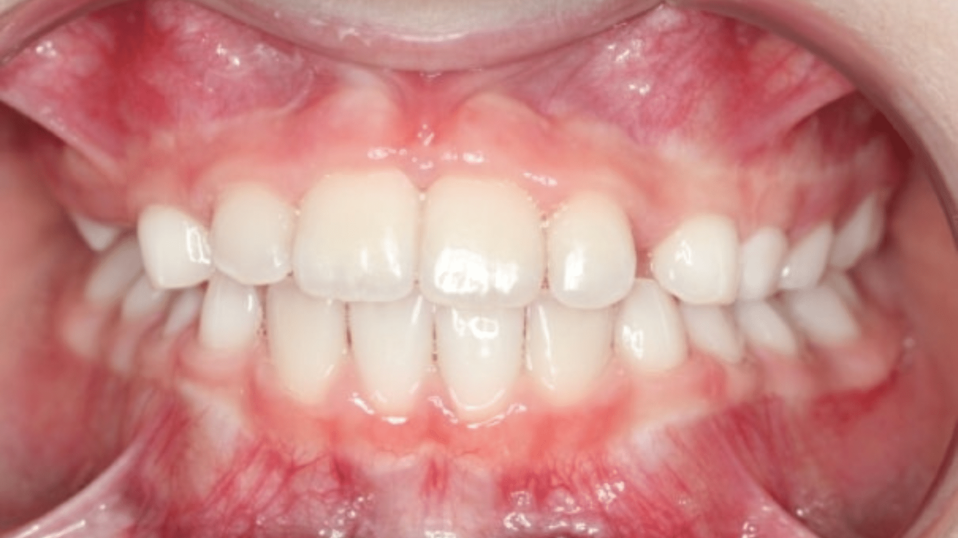 Smile Transformations At Marshall Orthodontics, in Great Falls, Havre, and Glasgow, MT.