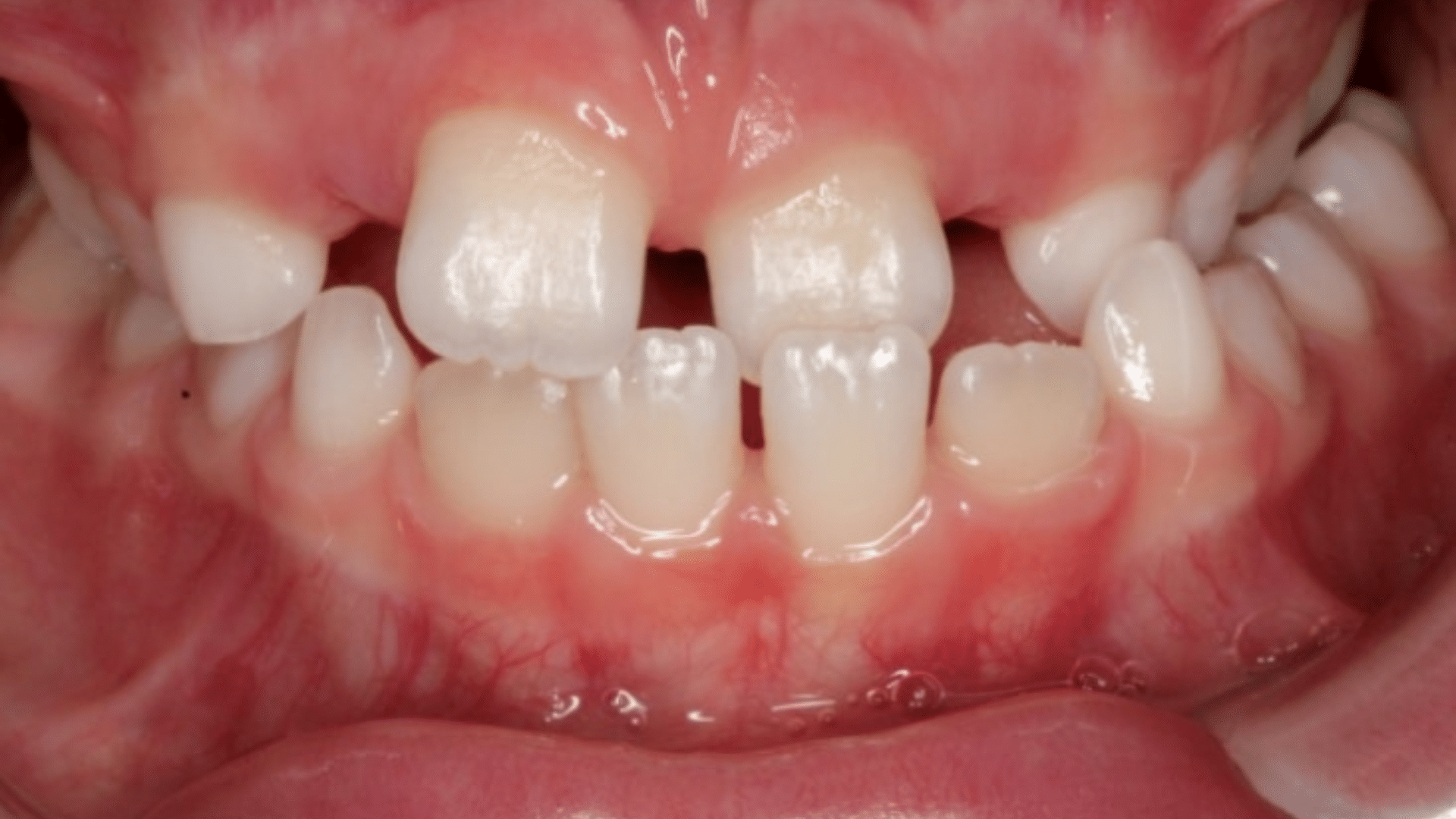 Smile Transformations At Marshall Orthodontics, in Great Falls, Havre, and Glasgow, MT.