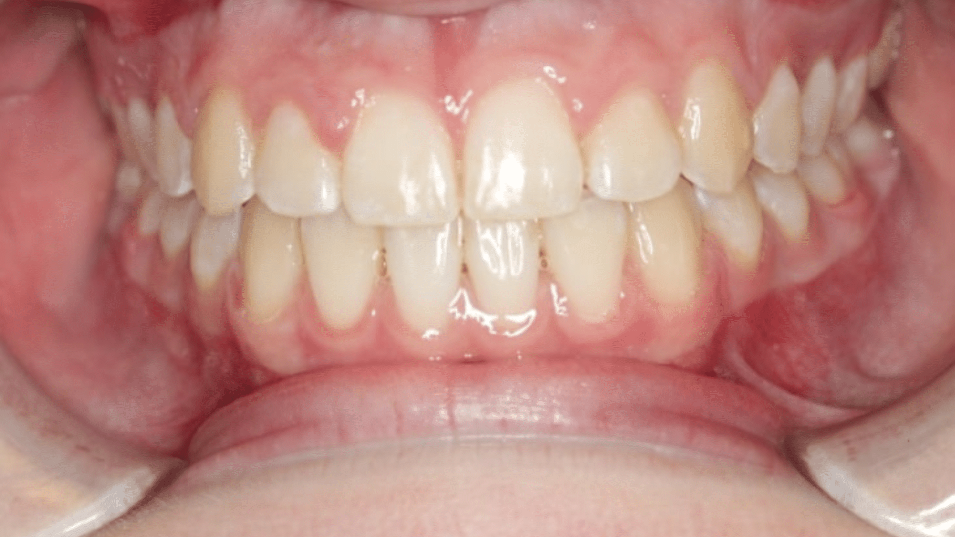 Smile Transformations At Marshall Orthodontics, in Great Falls, Havre, and Glasgow, MT.