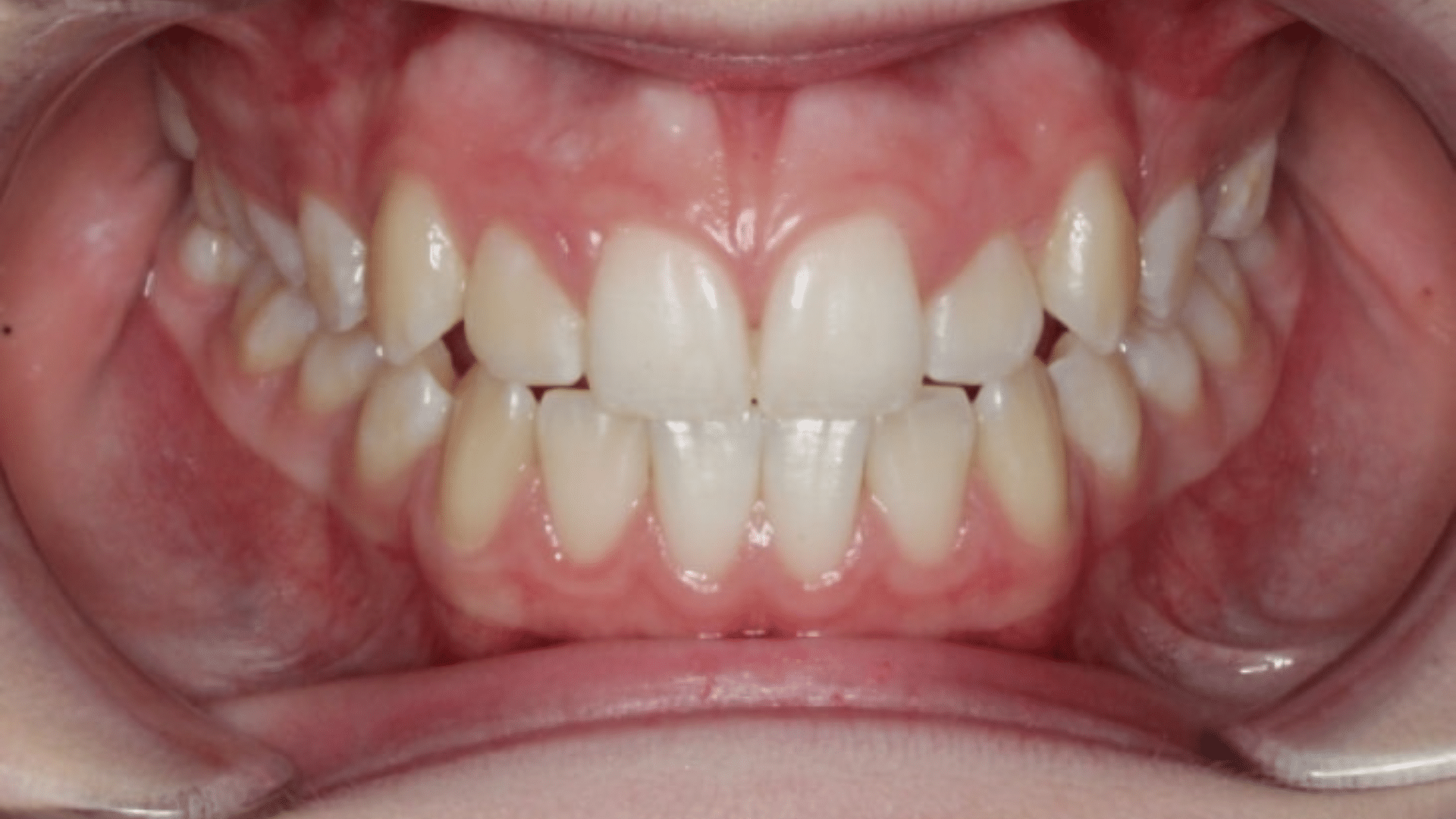 Smile Transformations At Marshall Orthodontics, in Great Falls, Havre, and Glasgow, MT.